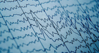qEEG: Everything You Need to Know About Brain Mapping